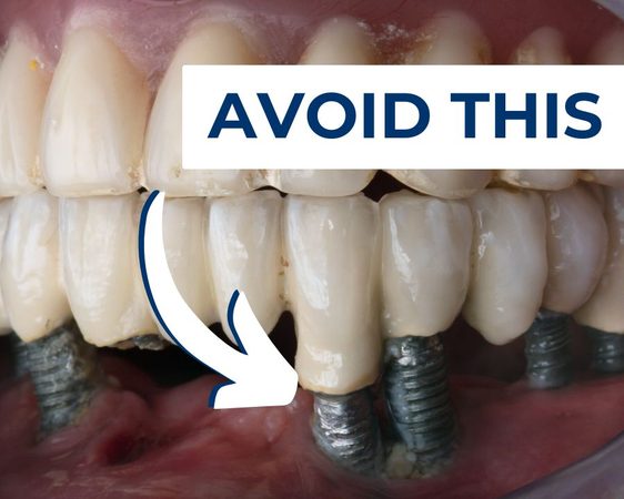 Botched Smile or Failed Implants?