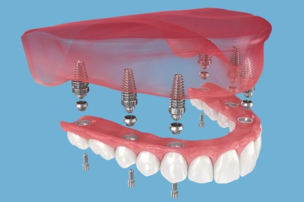 Sedation Options