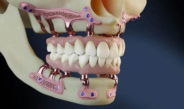 Told You Can't Get Dental Implants? There's Still Hope. We May Have a Solution.